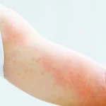 Get to Know Pellagra, a Deficiency in Vitamin B3 Homepage