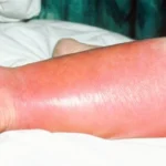Have You Heard About the Skin Infection Called St. Anthony’s Fire? Homepage