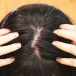Banish Itchy Scalp this Summer with Home Treatments Homepage