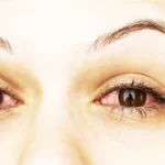 Treat Pink Eye Naturally with These Remedies Homepage