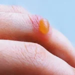 Treat Blisters with Essential Oils Homepage