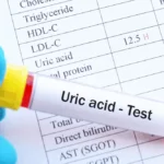 How to Lower Your Uric Acid Homepage